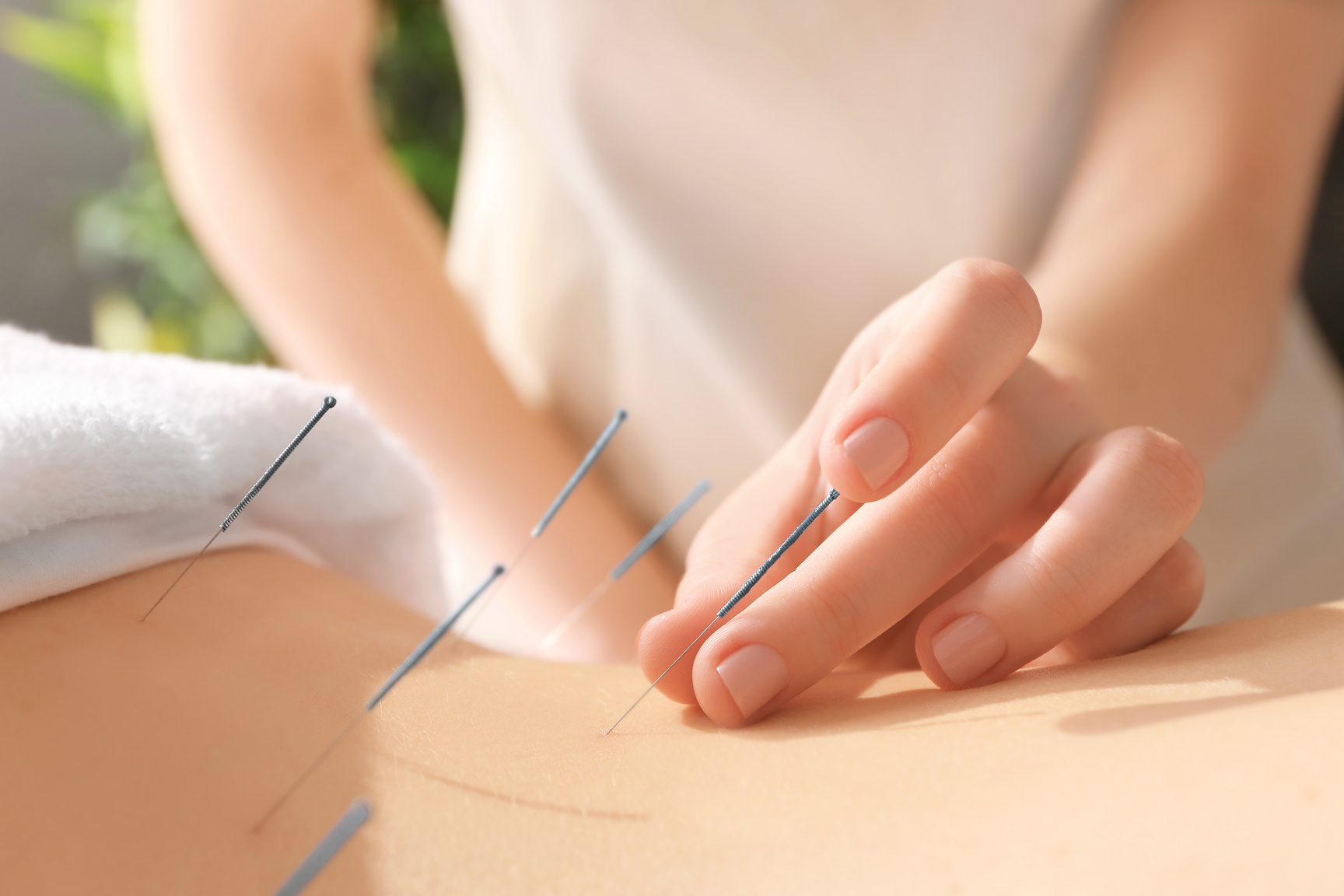 Young Woman Undergoing Acupuncture Treatment